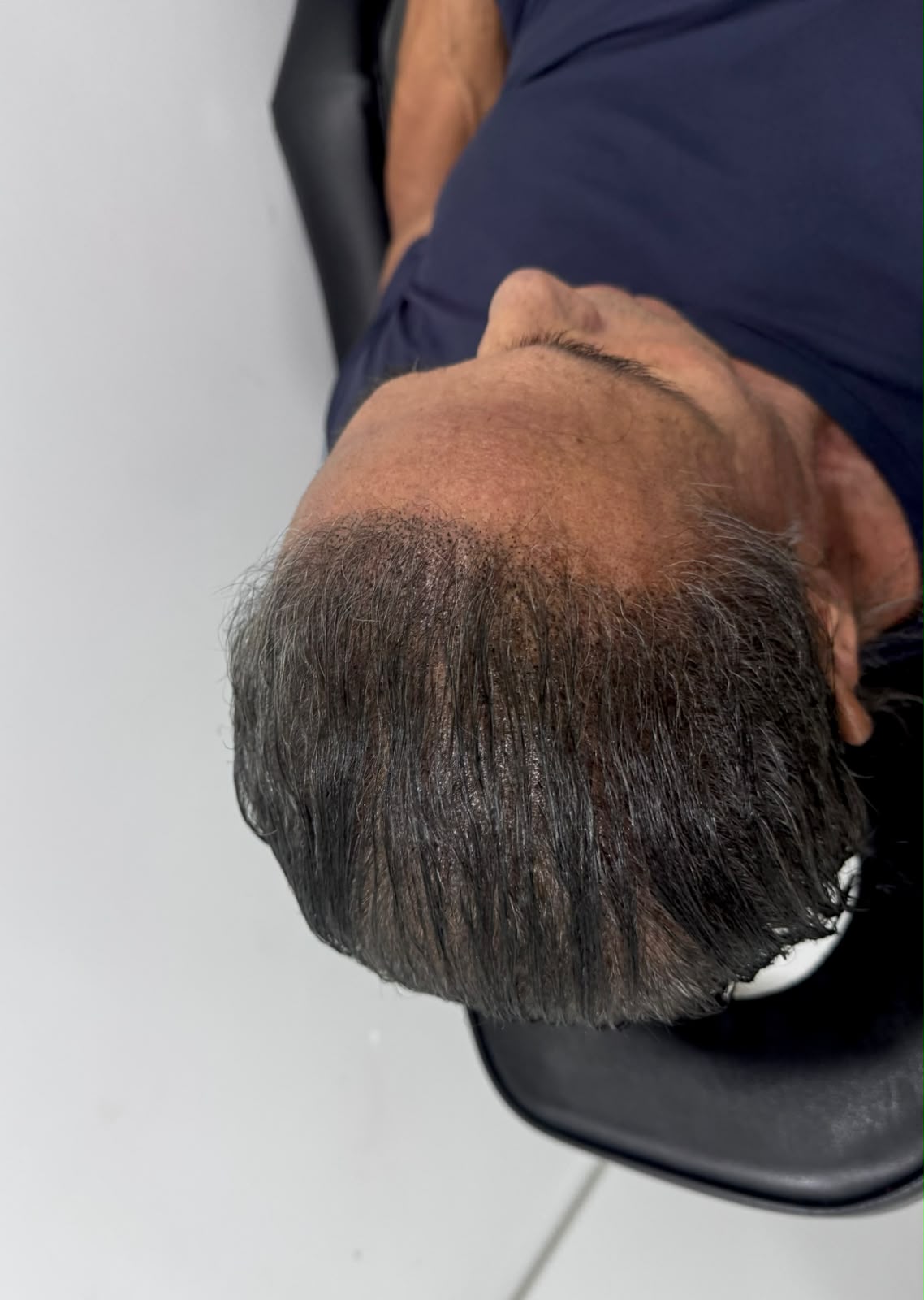 SMP Tijuana client after scalp micropigmentation - natural density restored on crown