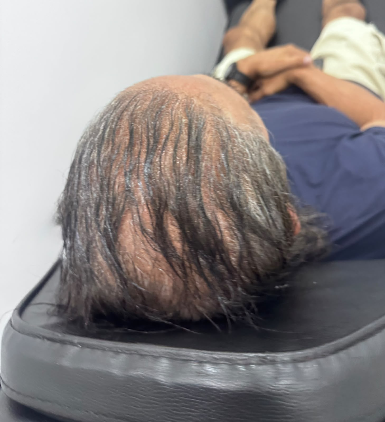 SMP Tijuana client before scalp micropigmentation treatment - hair thinning on crown