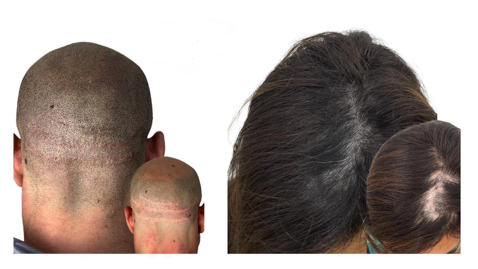 Multiple SMP clients before and after - scalp micropigmentation results for men and women in Tijuana