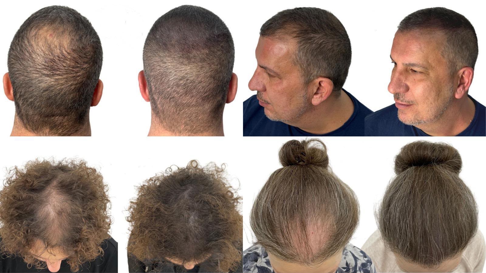 Scalp micropigmentation before and after crown baldness - SMP Tijuana near San Diego