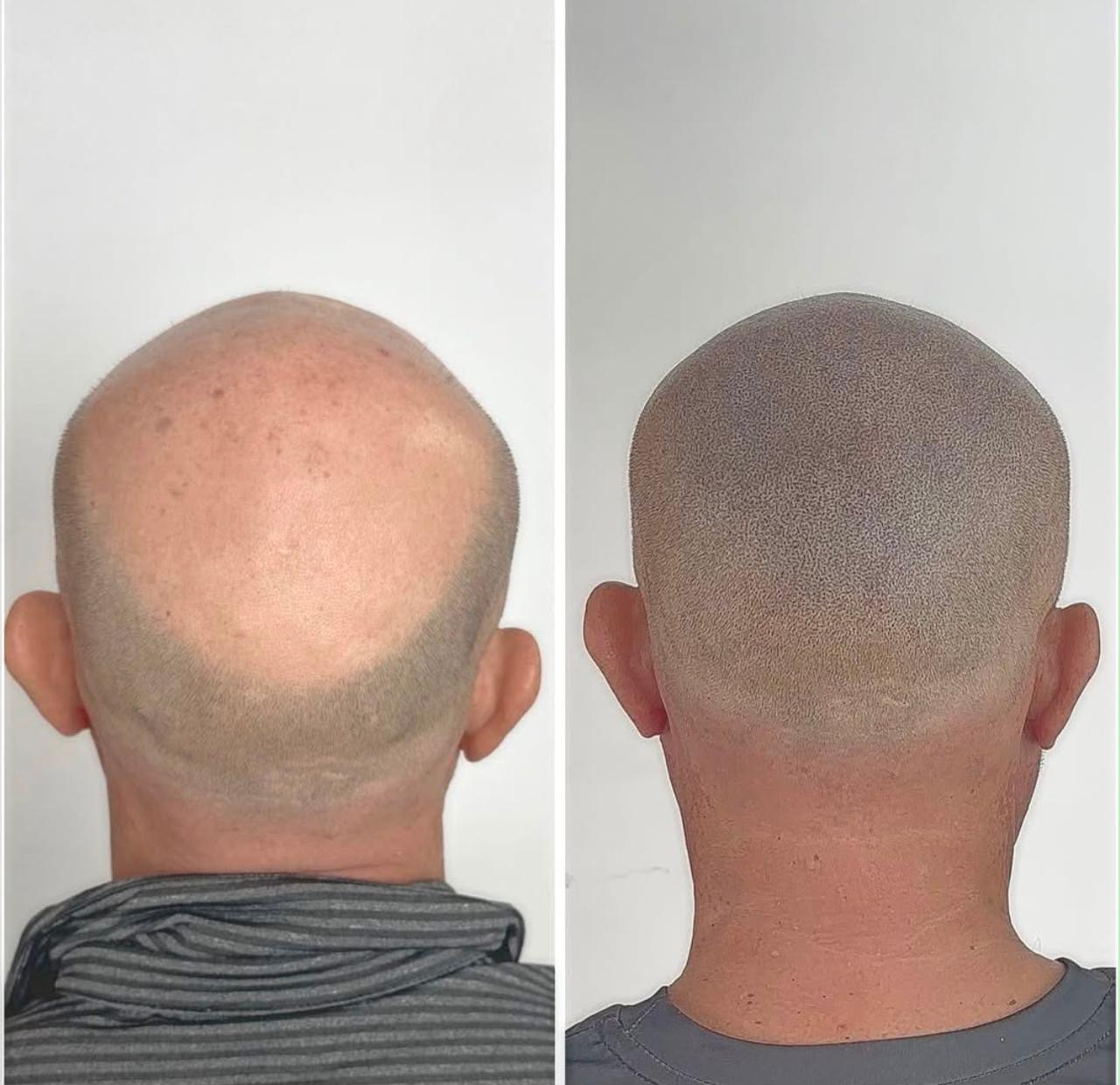 SMP full coverage result - bald client scalp micropigmentation before and after at SMP Tijuana