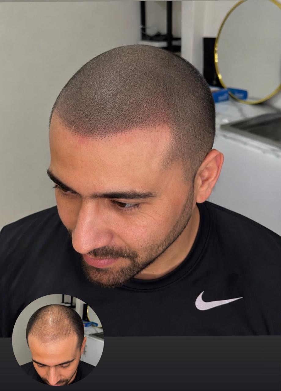 Scalp micropigmentation hairline result - SMP Tijuana client natural looking hair follicle simulation