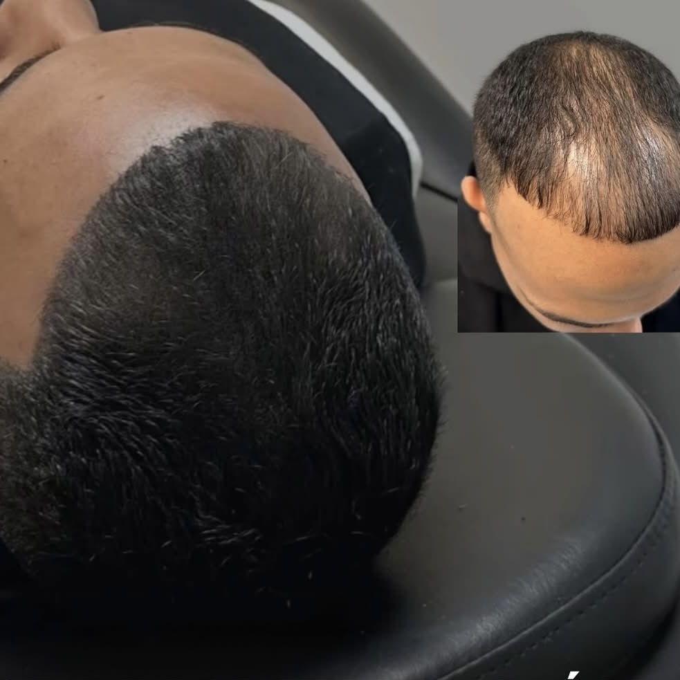 Scalp Micropigmentation Before and After - Real client result by Master Estefany Ruiz, SMP Tijuana at New City Medical Plaza.